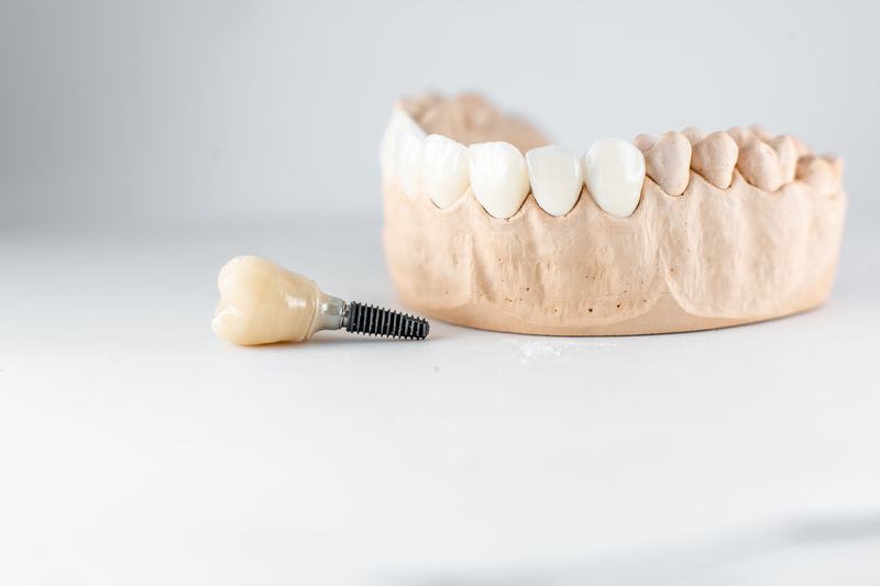 Modèle de mâchoire présentant un implant dentaire posé